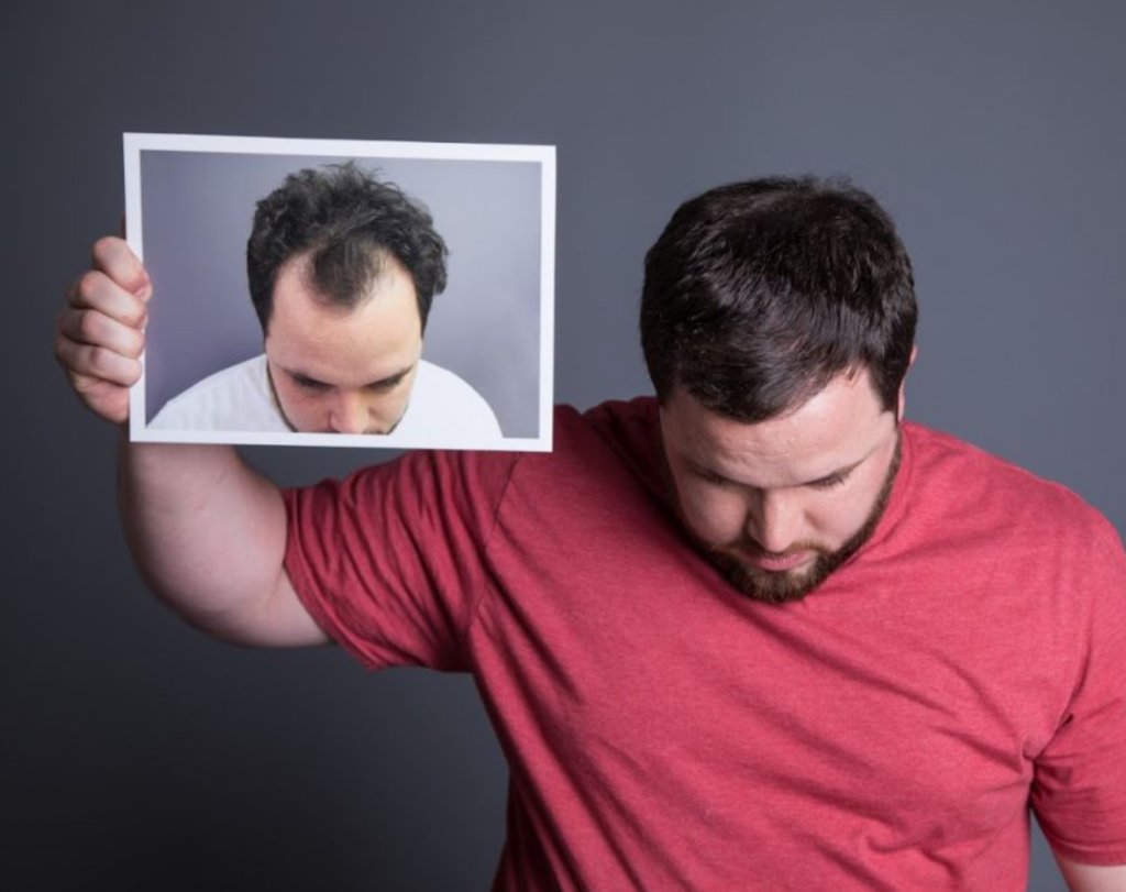 questions about hair transplantation
